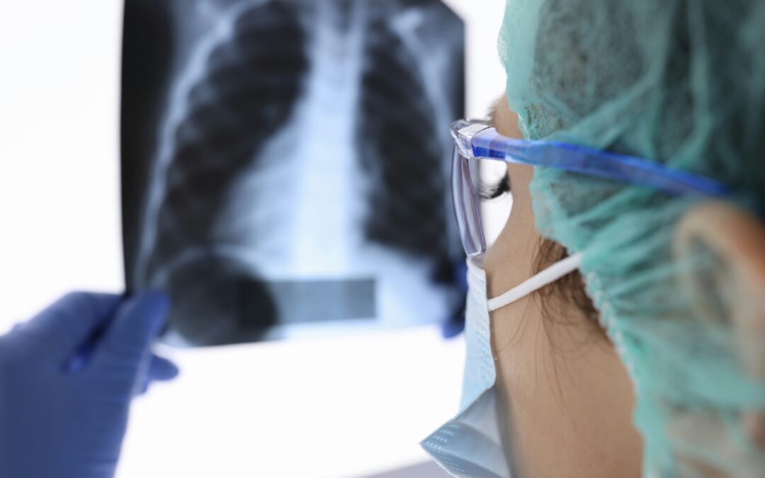 Pulmonary Embolism and Other Serious Lung Injuries After a Car Accident
