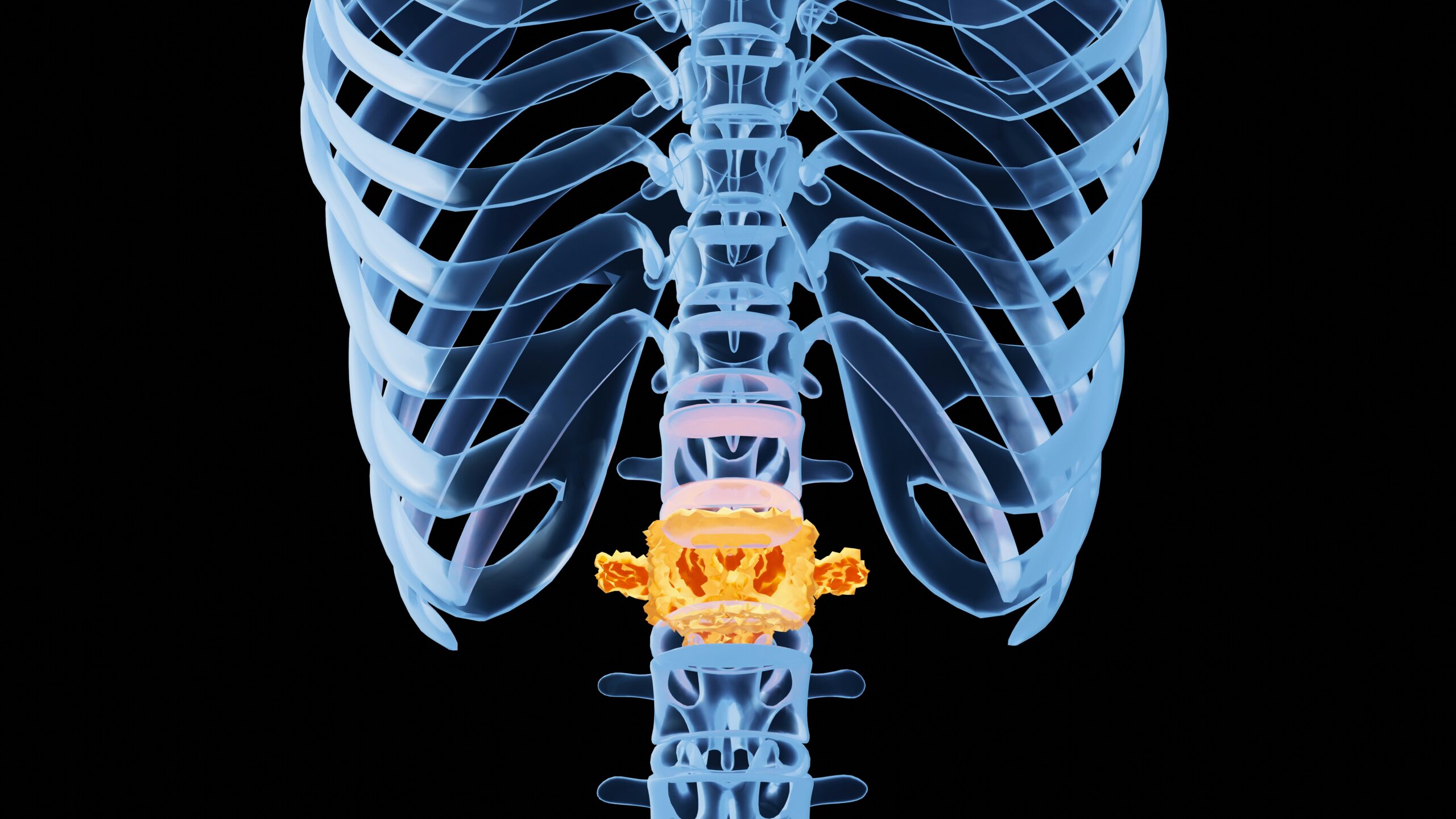 an image of the spine and rib cage. One section is lit up in orange, indicating pain
